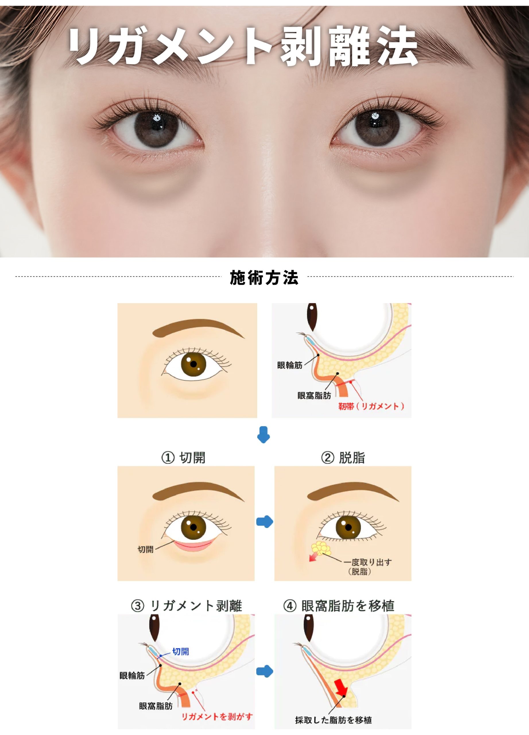リガメント剥離法