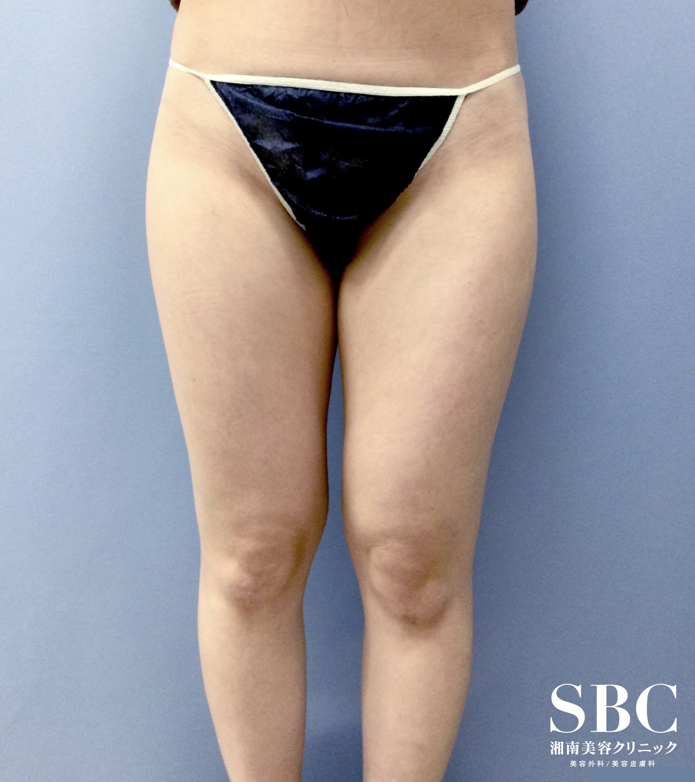 脂肪吸引・20代女性の術前の症例写真