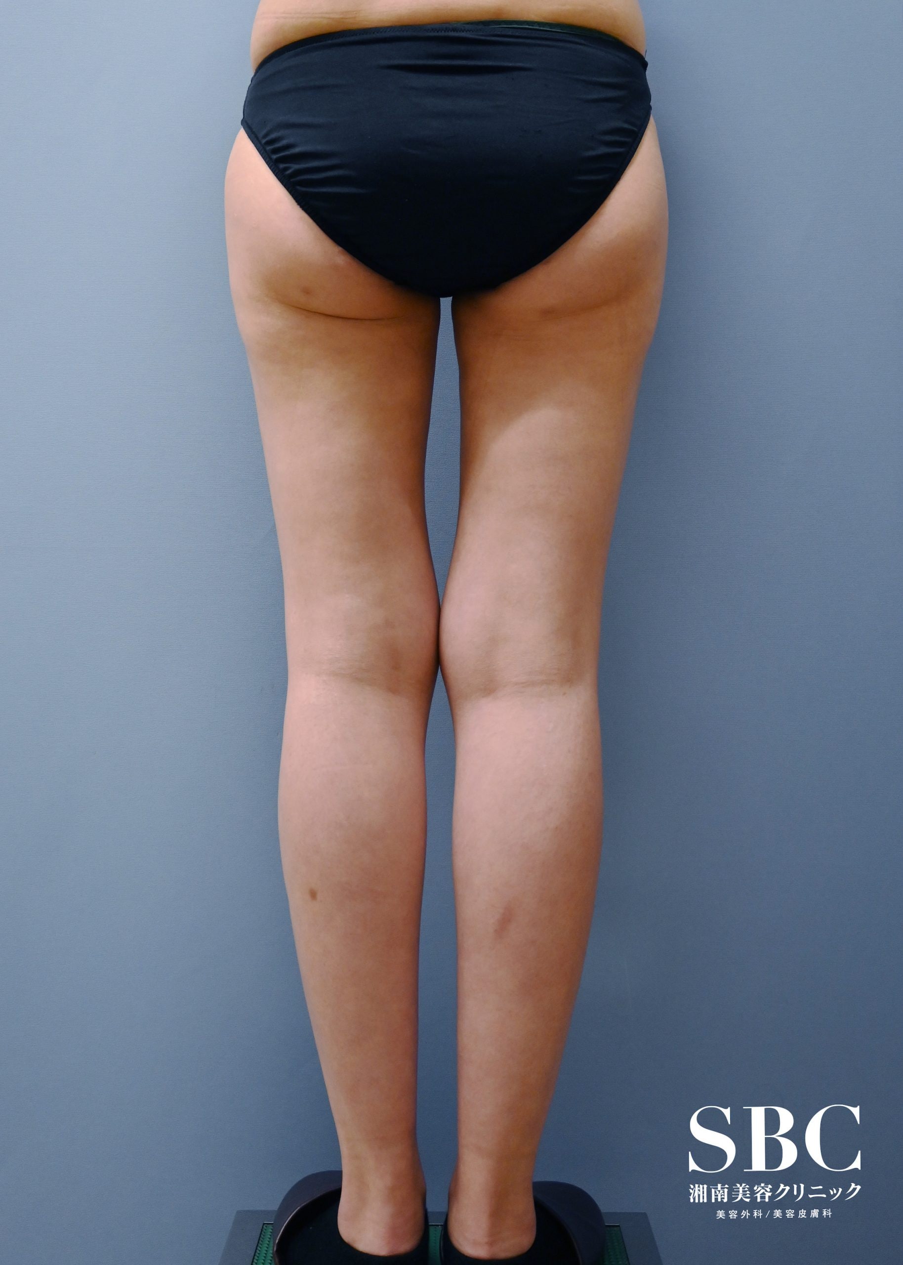 脂肪吸引・20代女性 の術後の症例写真