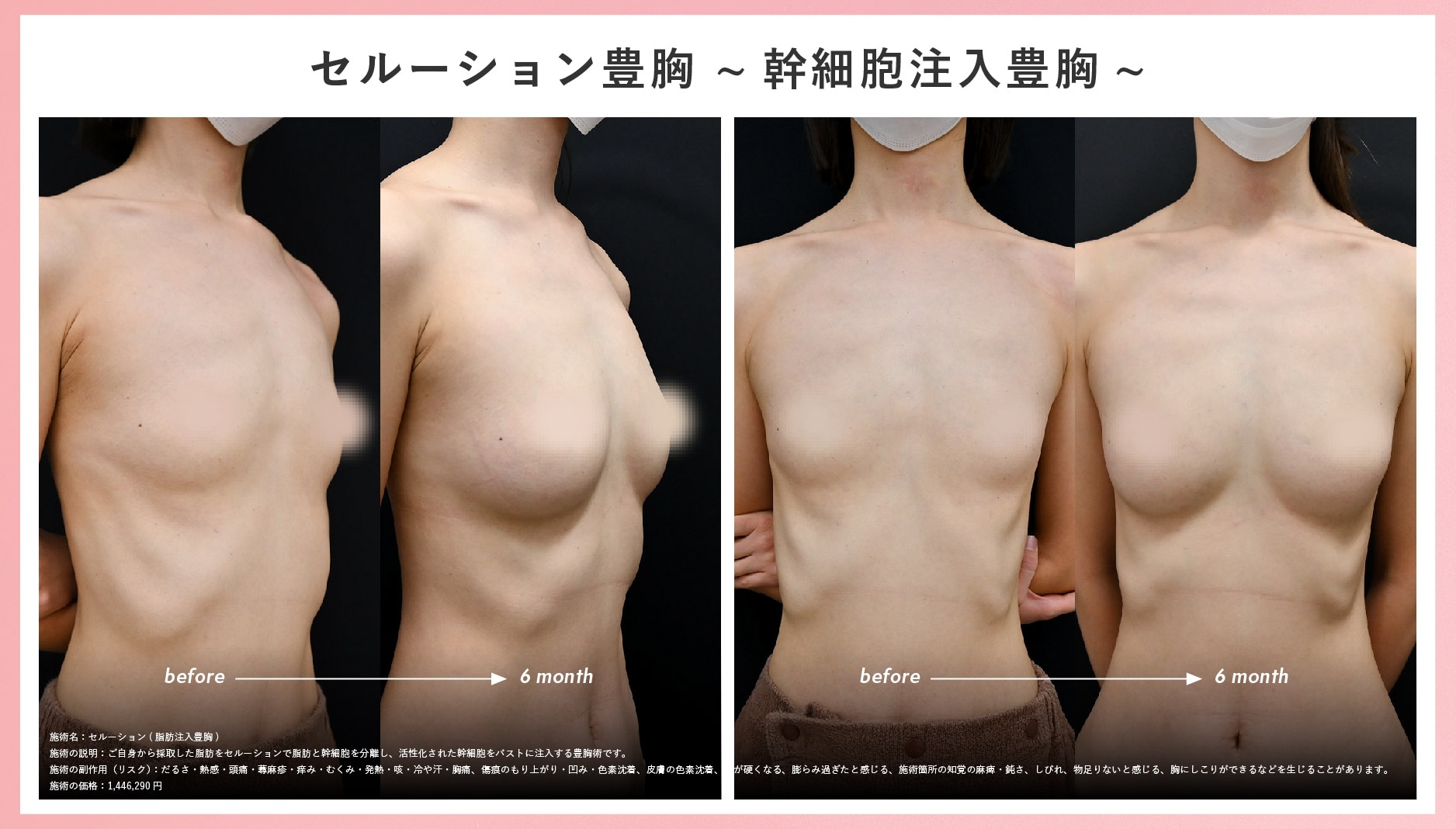 ふくらみかけの乳房 