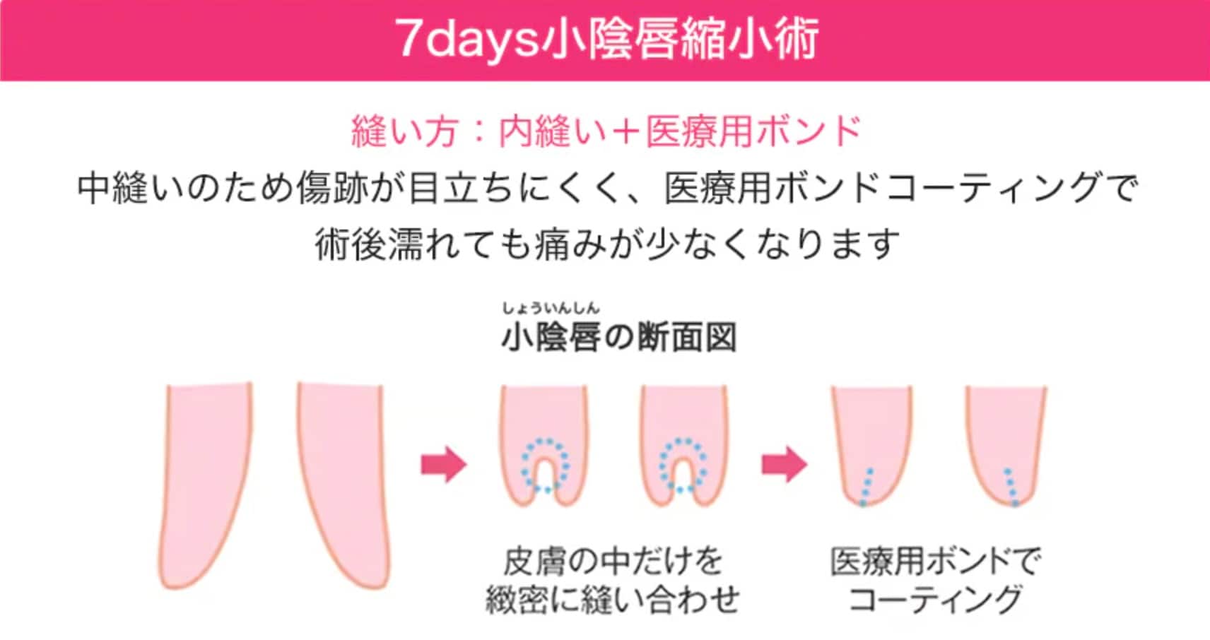 ダウンタイムの長さが気になる方は抜糸なし7daysがおすすめ