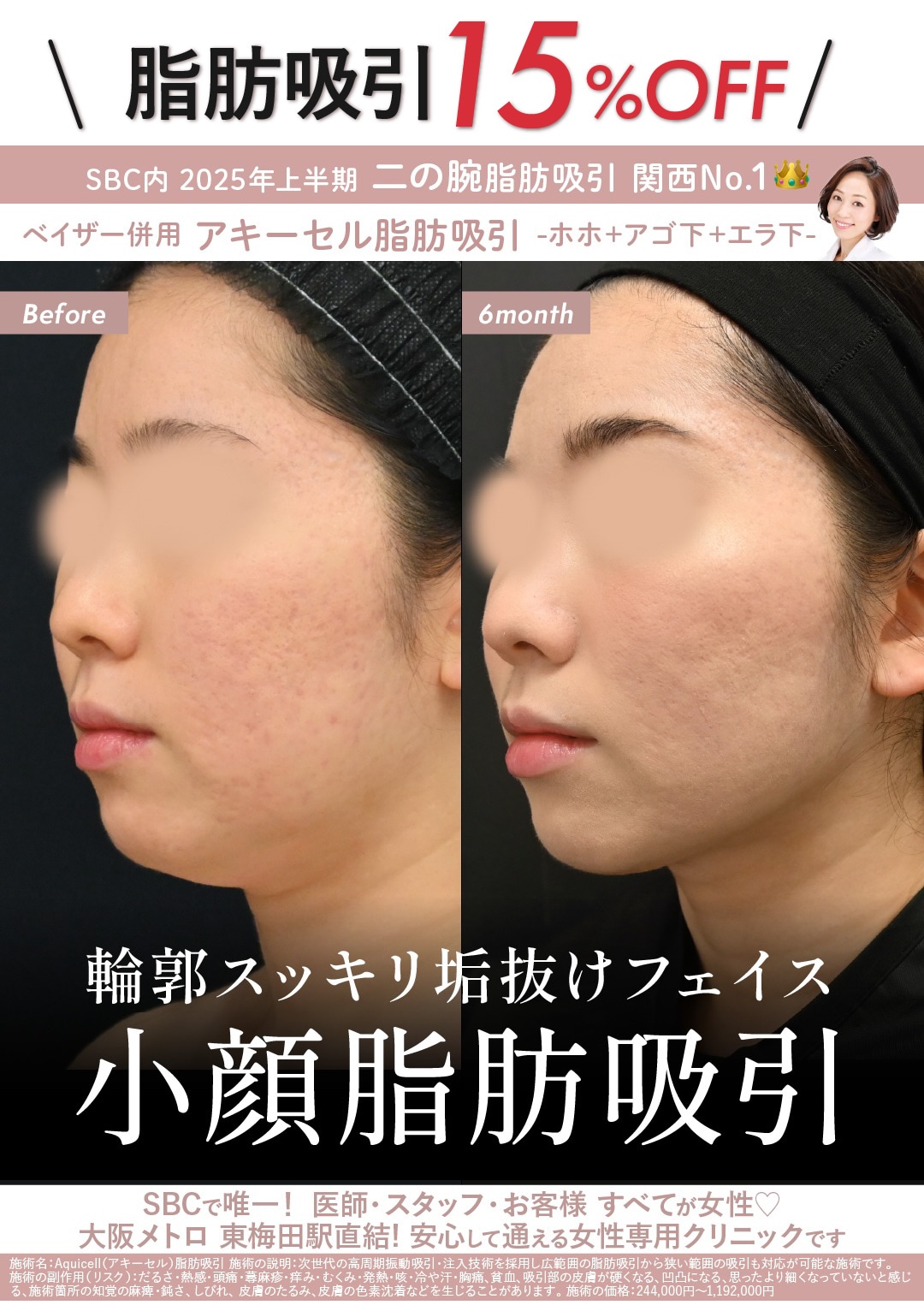 大阪駅前院でも大人気！脂肪吸引が15%OFFで受けれます！