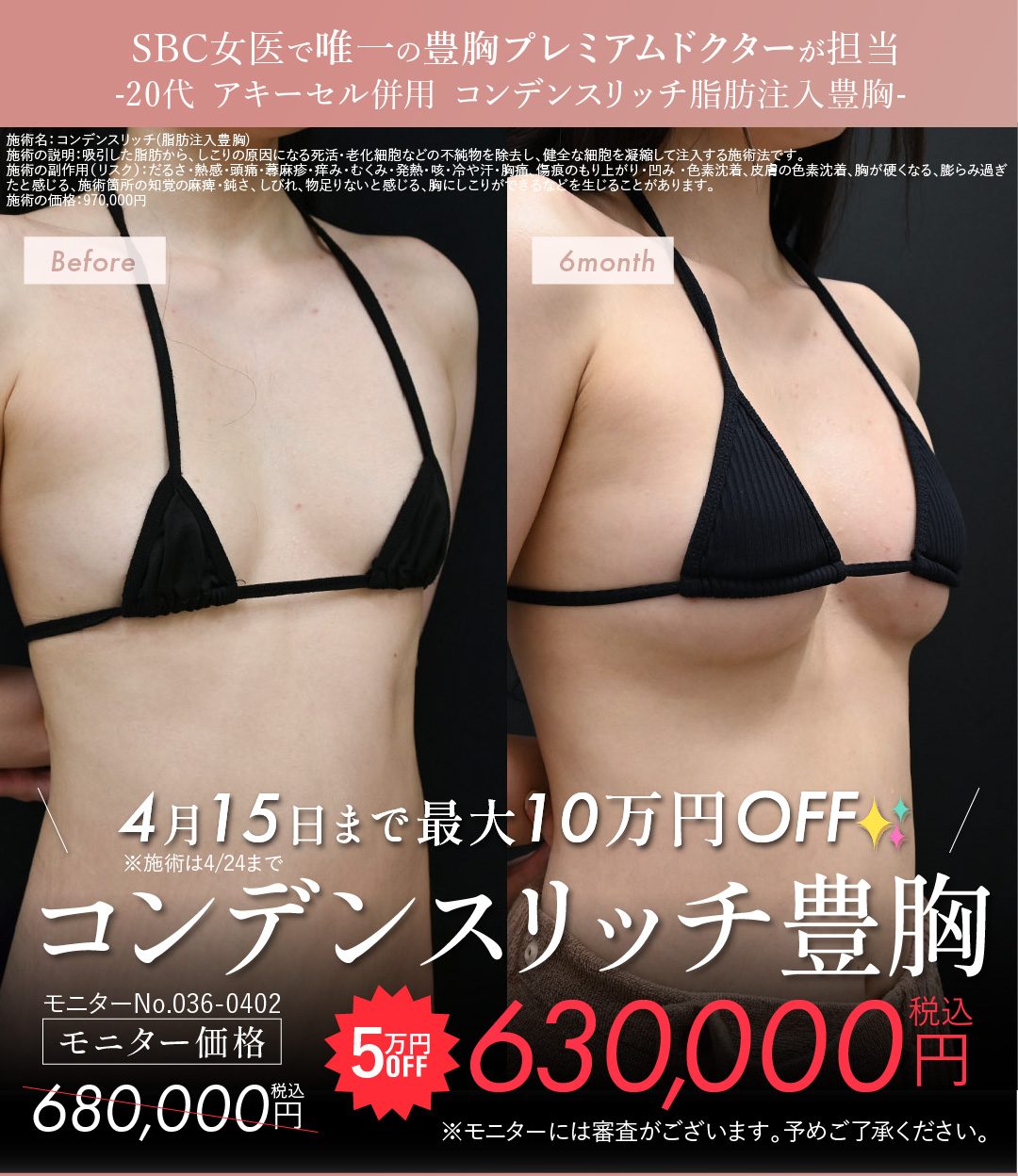 コンデンスリッチ豊胸