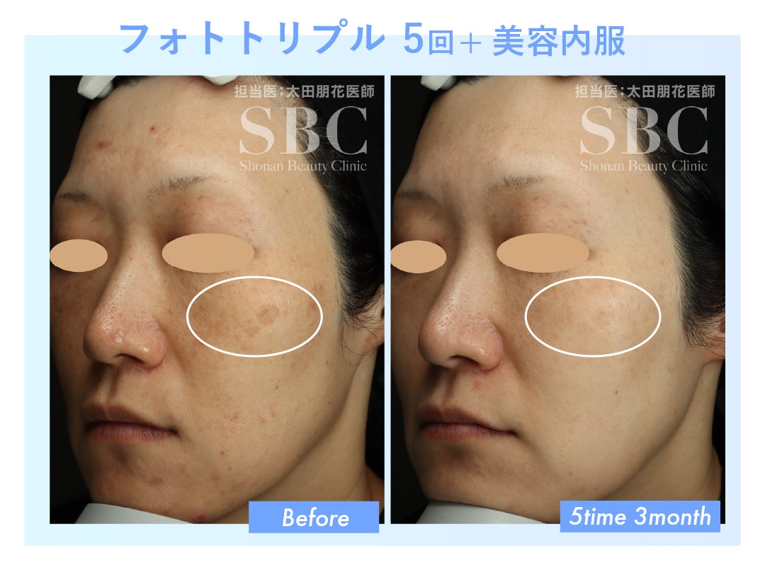 フォトトリプル5回のビフォーアフター