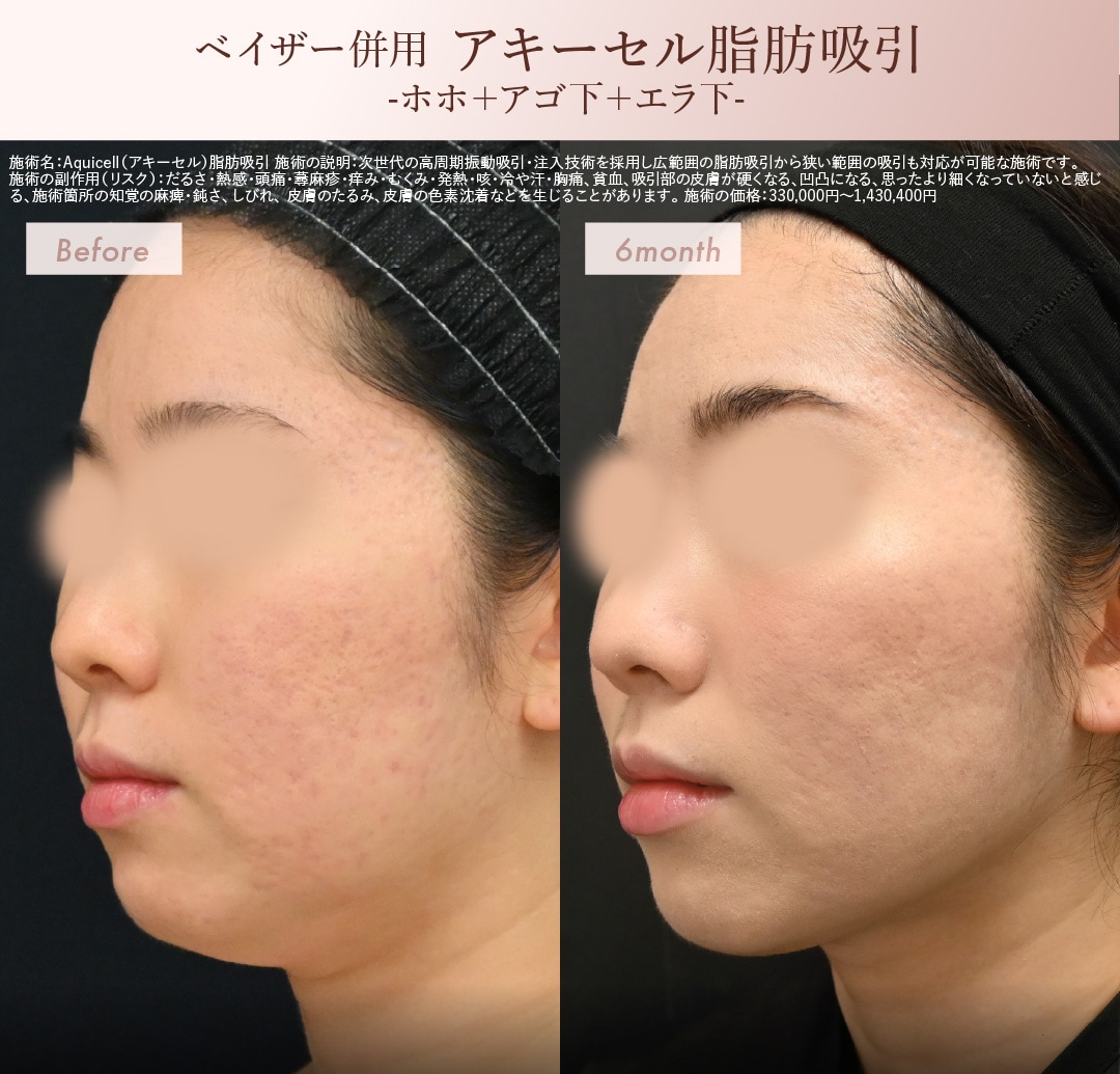 脂肪吸引