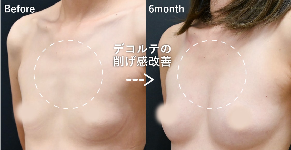 デコルテの削げも改善