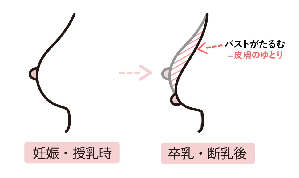 脂肪が定着しやすい