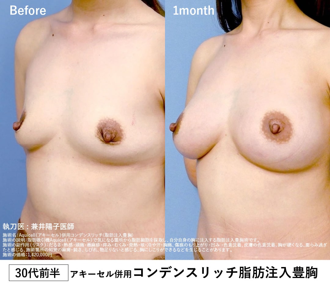 【30代前半・授乳歴あり】脂肪注入豊胸