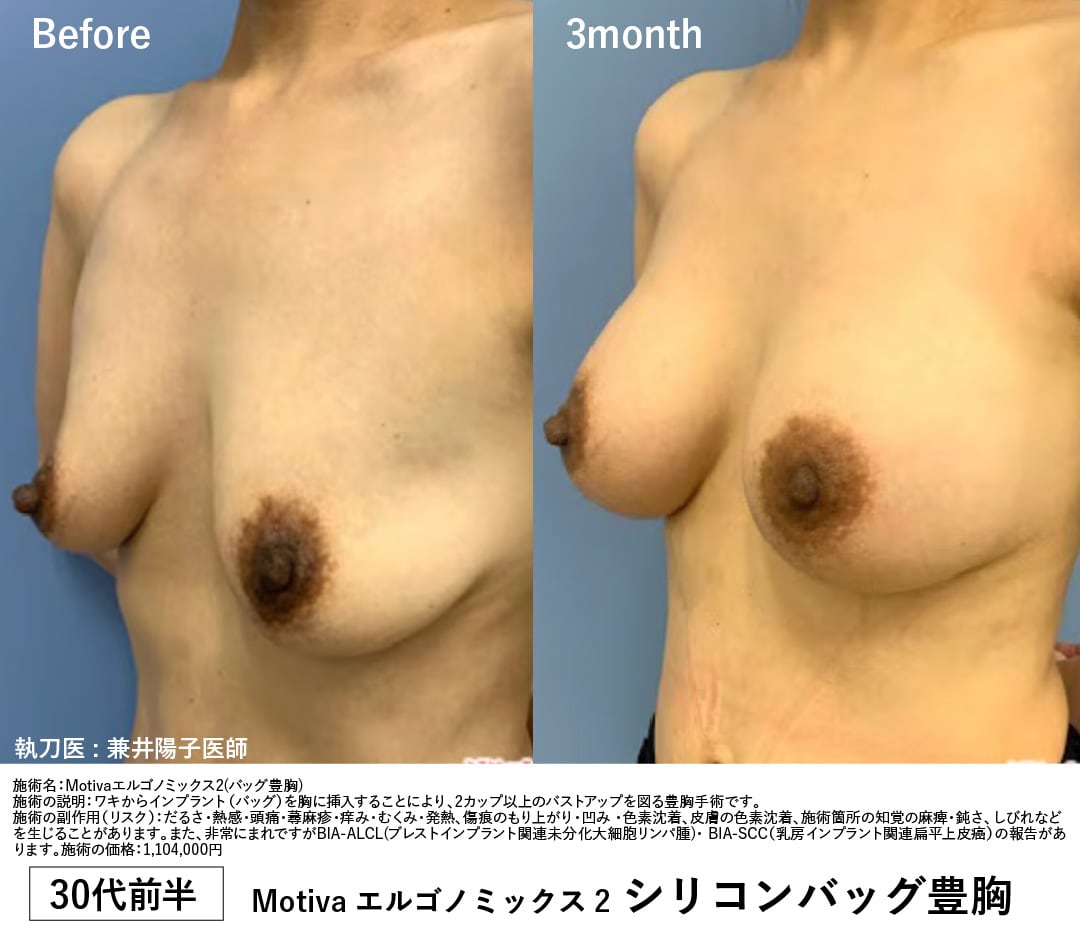 【30代前半・授乳歴あり】シリコンバッグ豊胸