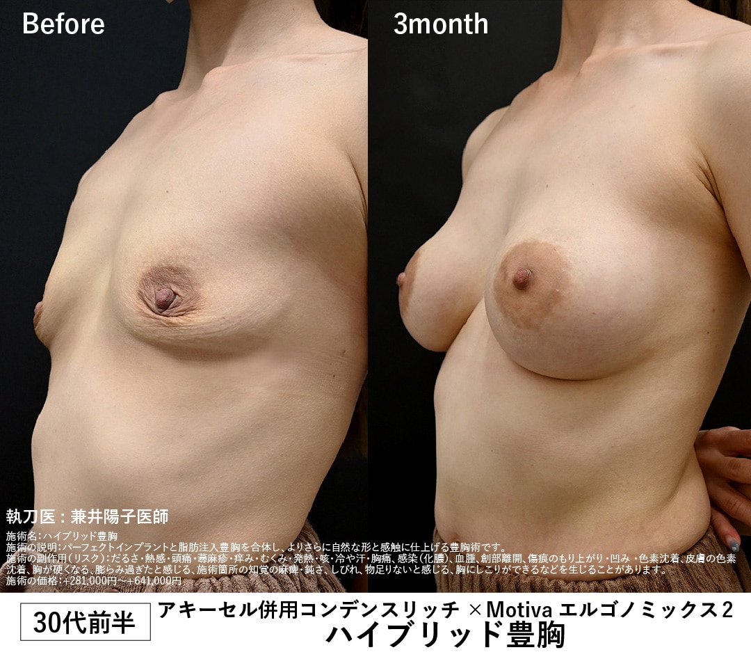 【30代前半・授乳歴あり】ハイブリッド豊胸