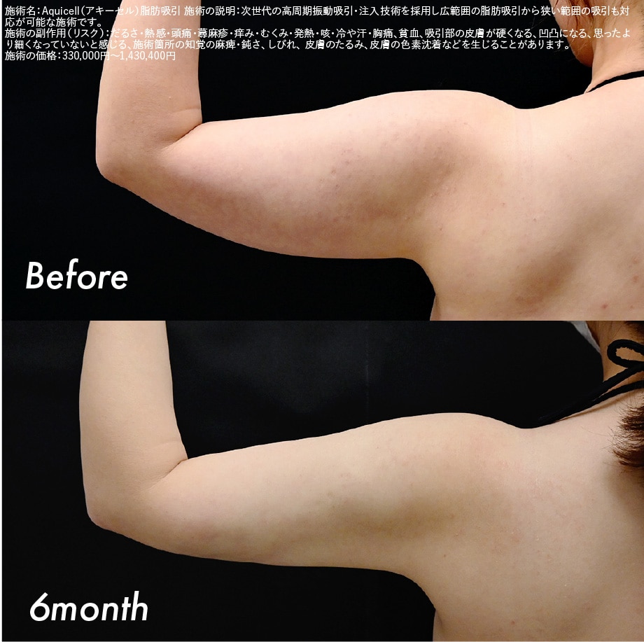 【30代】二の腕＋肩
