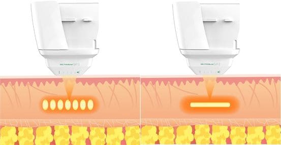 ハイフプログラムの特徴
