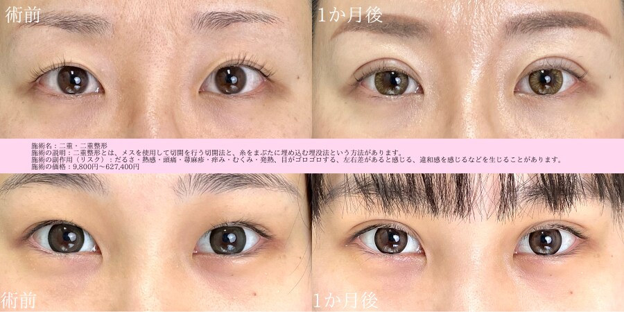 切らない埋没二重術が半額<br />
クイックコスメティークNeo法 84,000円(税込)<br />
モニター番号:063-0331