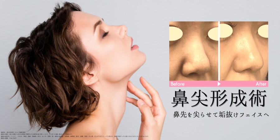 鼻先を尖らせて一気に垢抜けフェイスへ<br />
『鼻尖形成術(だんご鼻解消術)』 39,300円 (税込)<br />
モニター番号:063-0326