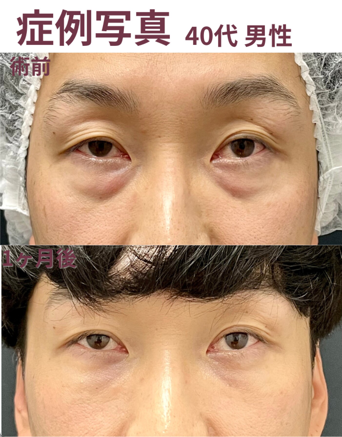 40代 男性<br />
【施術内容】<br />
目の下の切らないたるみ取り<br />
ナノリッチフェイス(目の下〜ゴルゴ線)