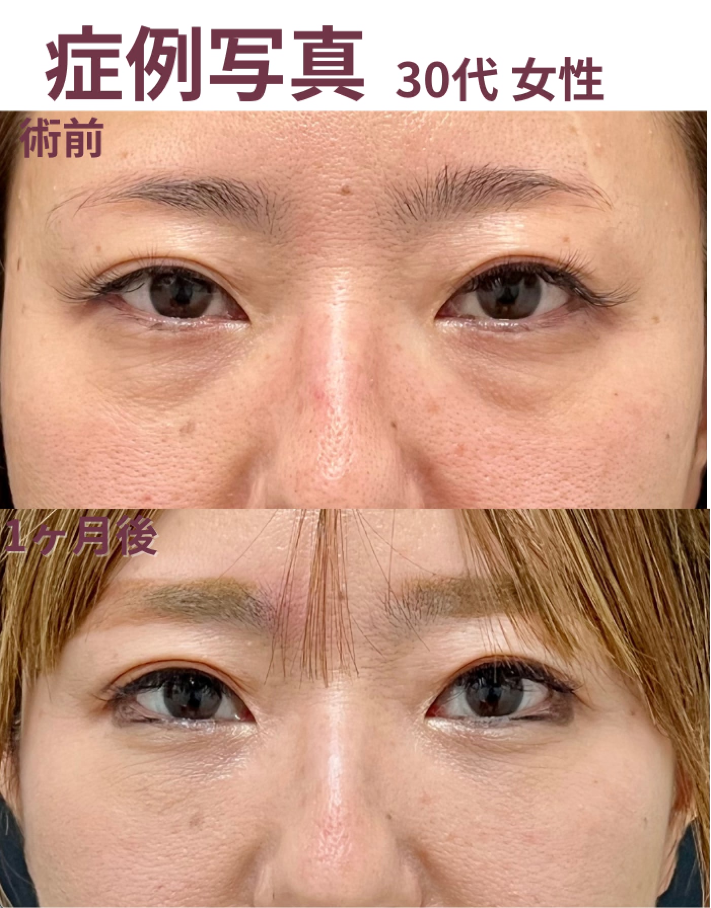 30代 女性<br />
【施術内容】<br />
目の下の切らないたるみ取り<br />
コンデンスリッチフェイス(目の下〜ゴルゴ線)