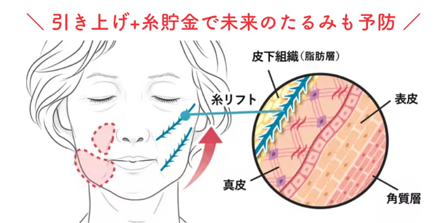 下垂脂肪を直接持ち上げ、美しい位置に脂肪を再配置