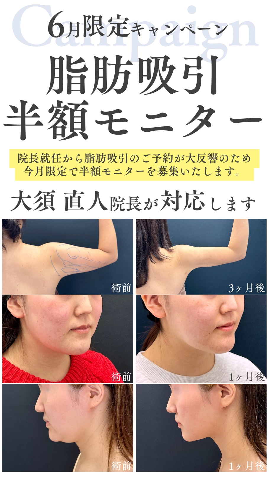 脂肪吸引半額モニター募集中