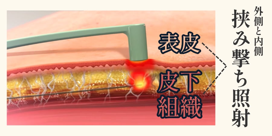 内側と外側からの「挟み撃ち」照射