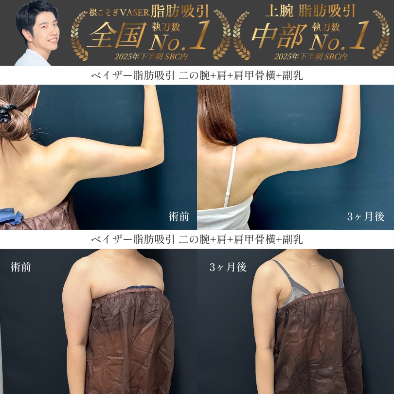 全国から指名殺到中《二の腕脂肪吸引》