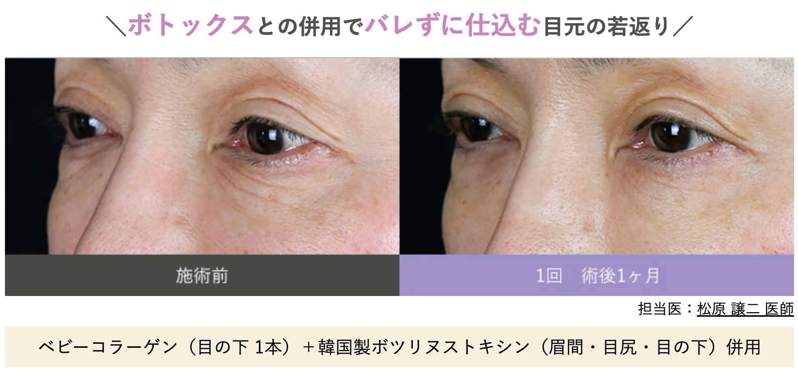 ボトックスとの併用でバレずに目元の若返り