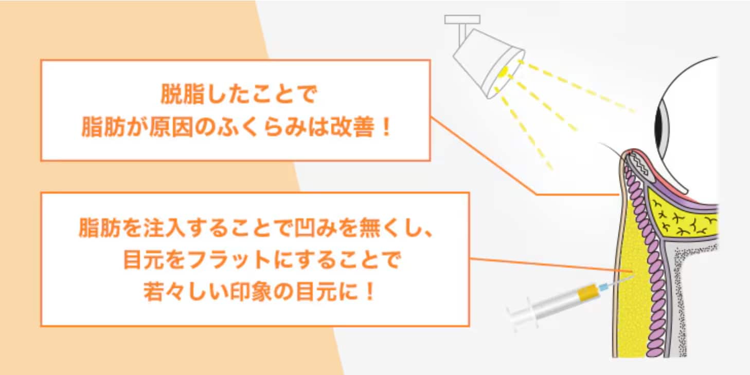 脂肪注入で定着率を高め、ハリのある美しい仕上がりへ