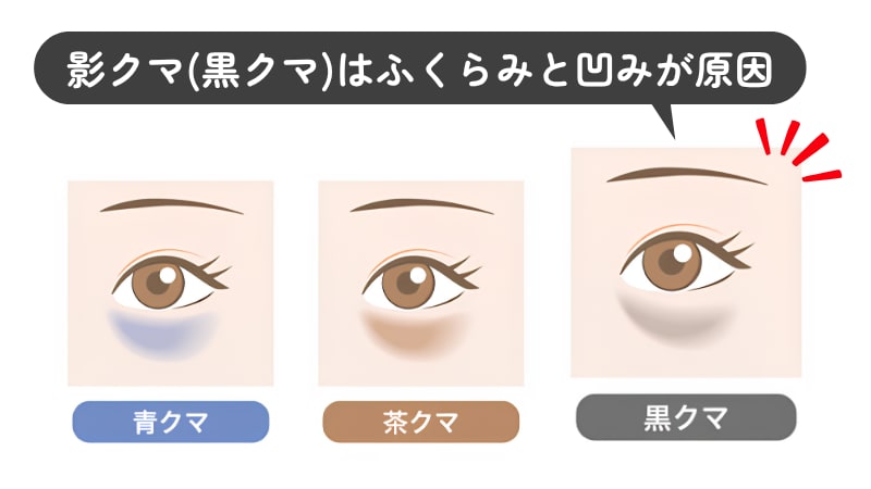 影クマ（黒クマ）：ふくらみと凹みが原因