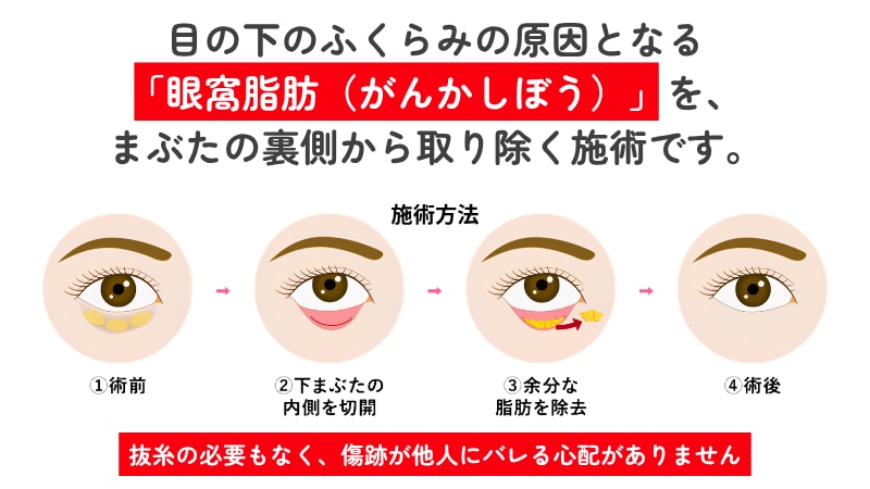 目の下の切らないクマ取り（経結膜脱脂法）の仕組みと定義