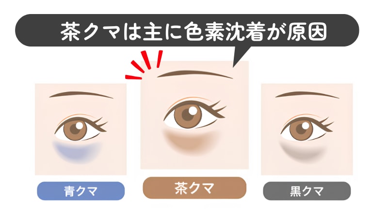 茶クマ：色素沈着が原因