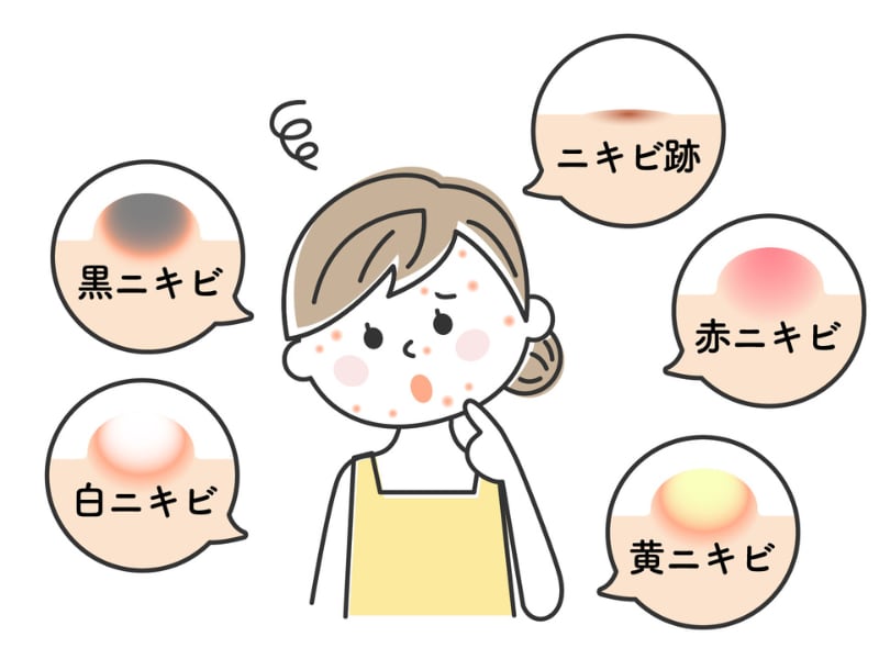 ニキビの種類と<br />
それぞれの症状に合わせた治療選択