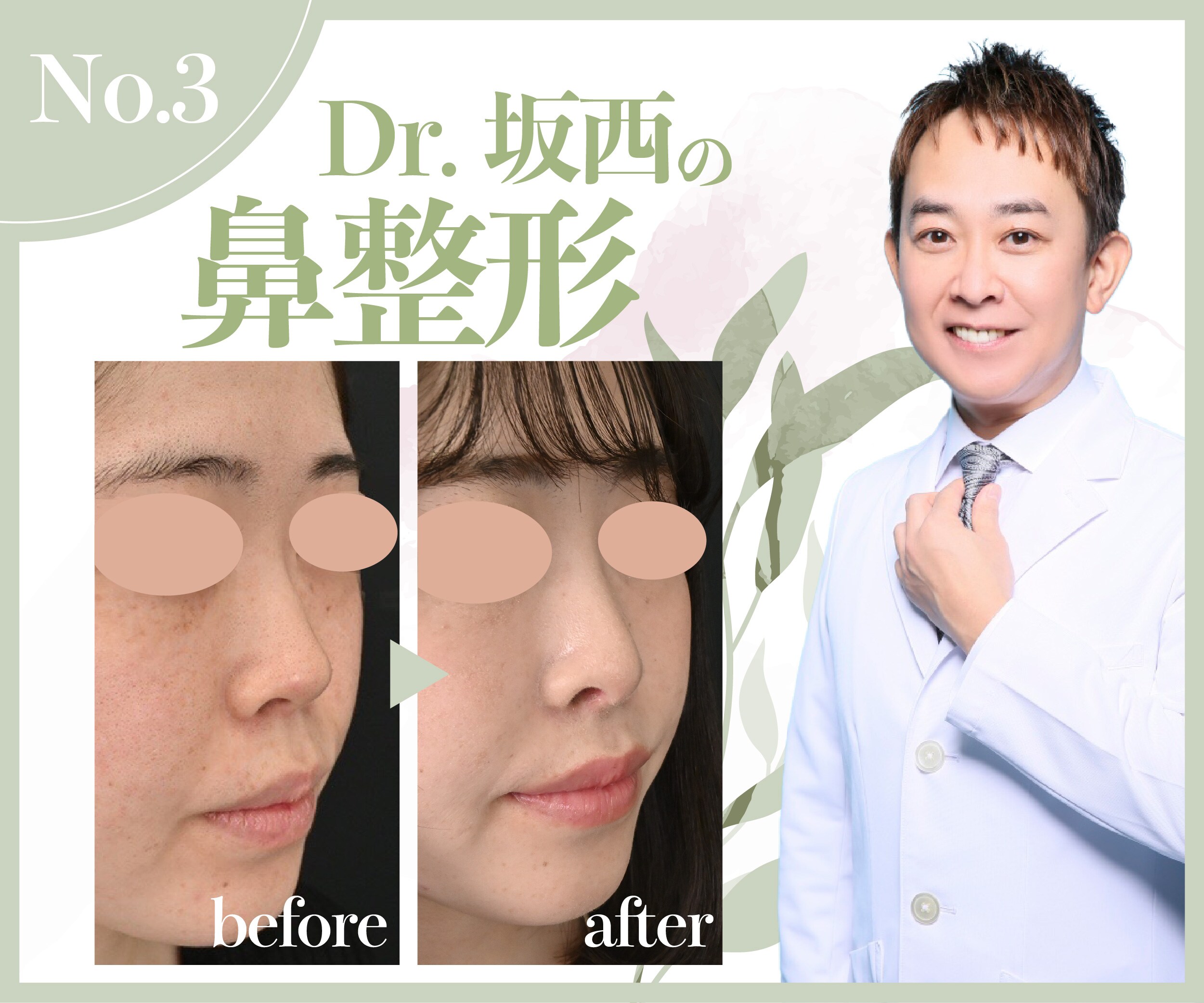 Dr.坂西の【鼻整形】SBC技術指導医による自然で最高の仕上がりの鼻へ