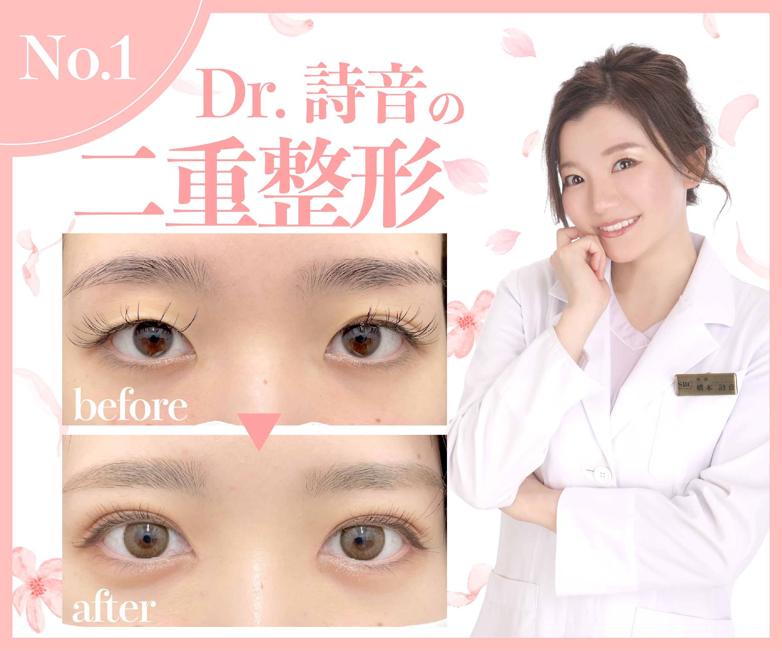 Dr.詩音の【二重整形】丁寧なカウンセリング・抜群のデザインセンス・繊細で正確な技術力で指名殺到❗️