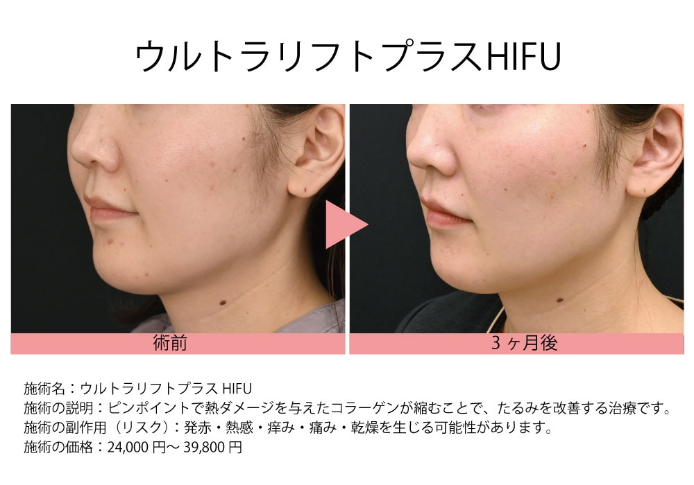 湘南美容クリニック新宿南口院の【ハイフ】治療：3つのハイフの違いと 