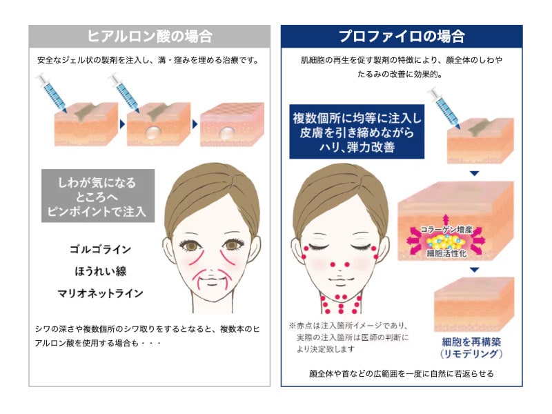 首のシワ対策には「プロファイロ」がおすすめ！その理由とは？ - 新宿 
