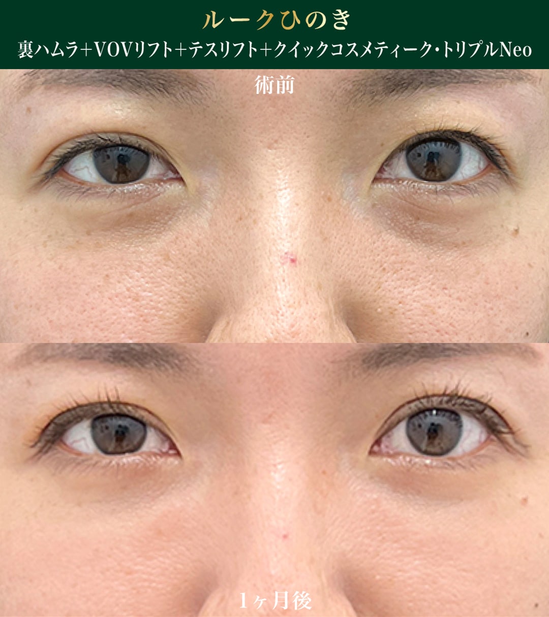 裏ハムラ×糸リフト】新宿南口院 Dr.ルークひのき（檜山和弘院長）の 