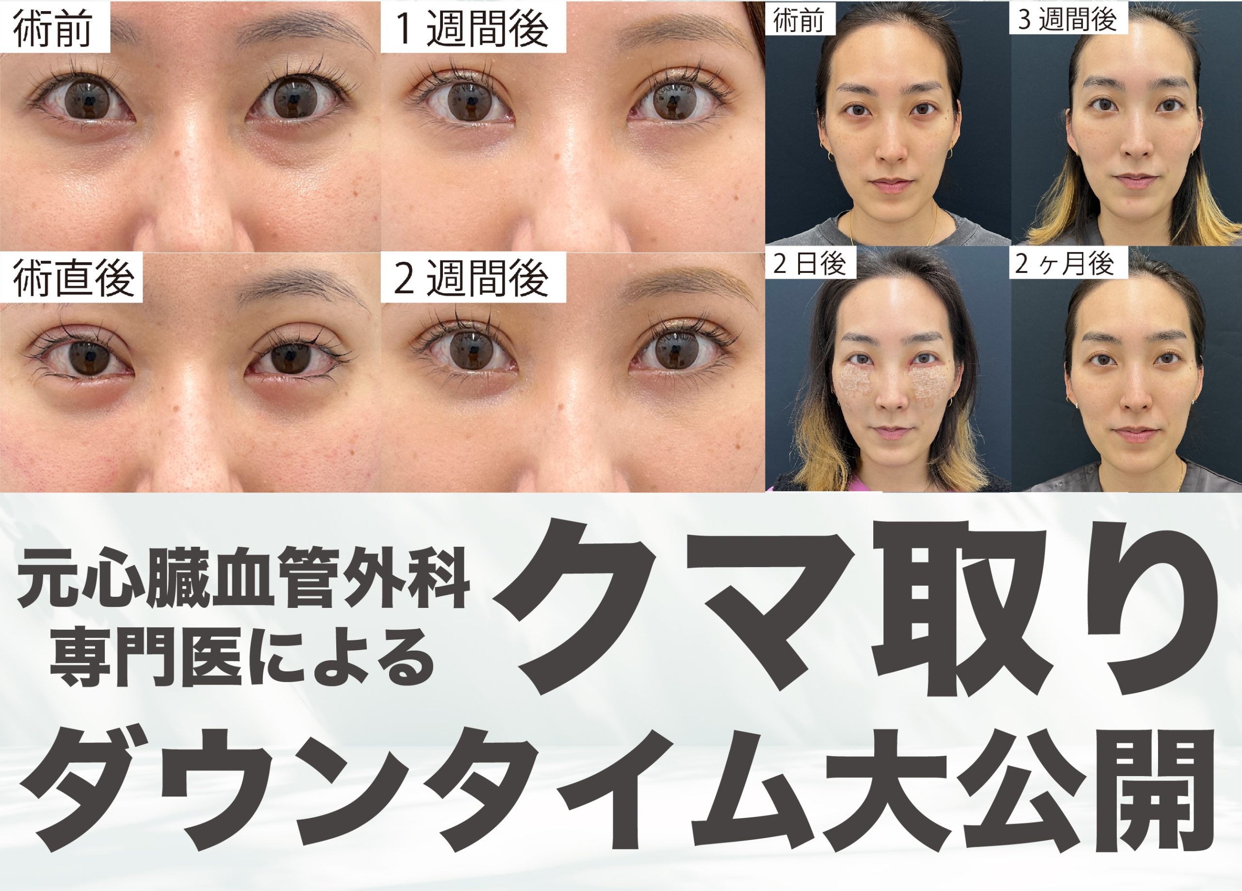 都内のクマ取り名医】新宿でクマ取りするなら元心臓血管外科専門医の  