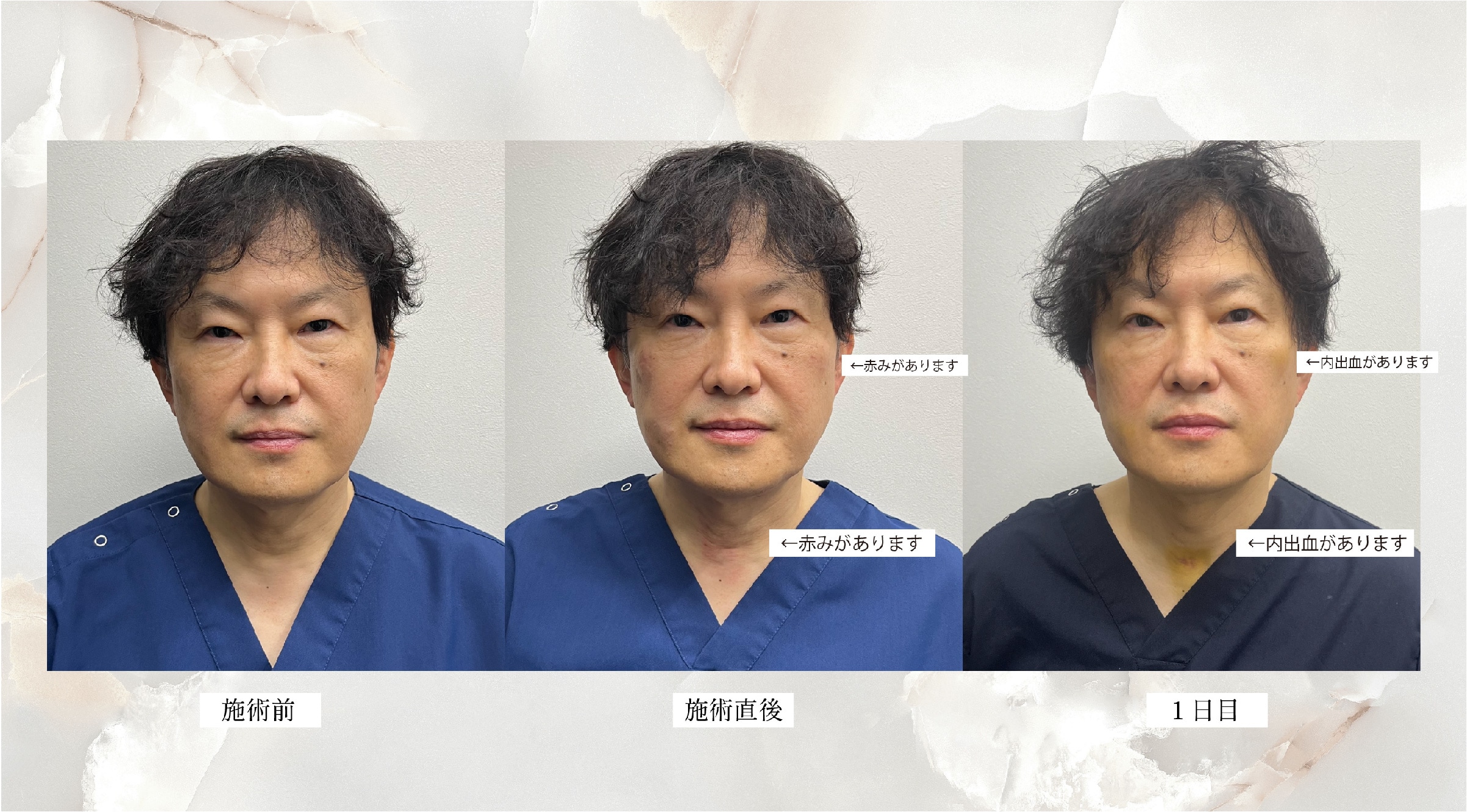 施術前〜施術直後〜翌日