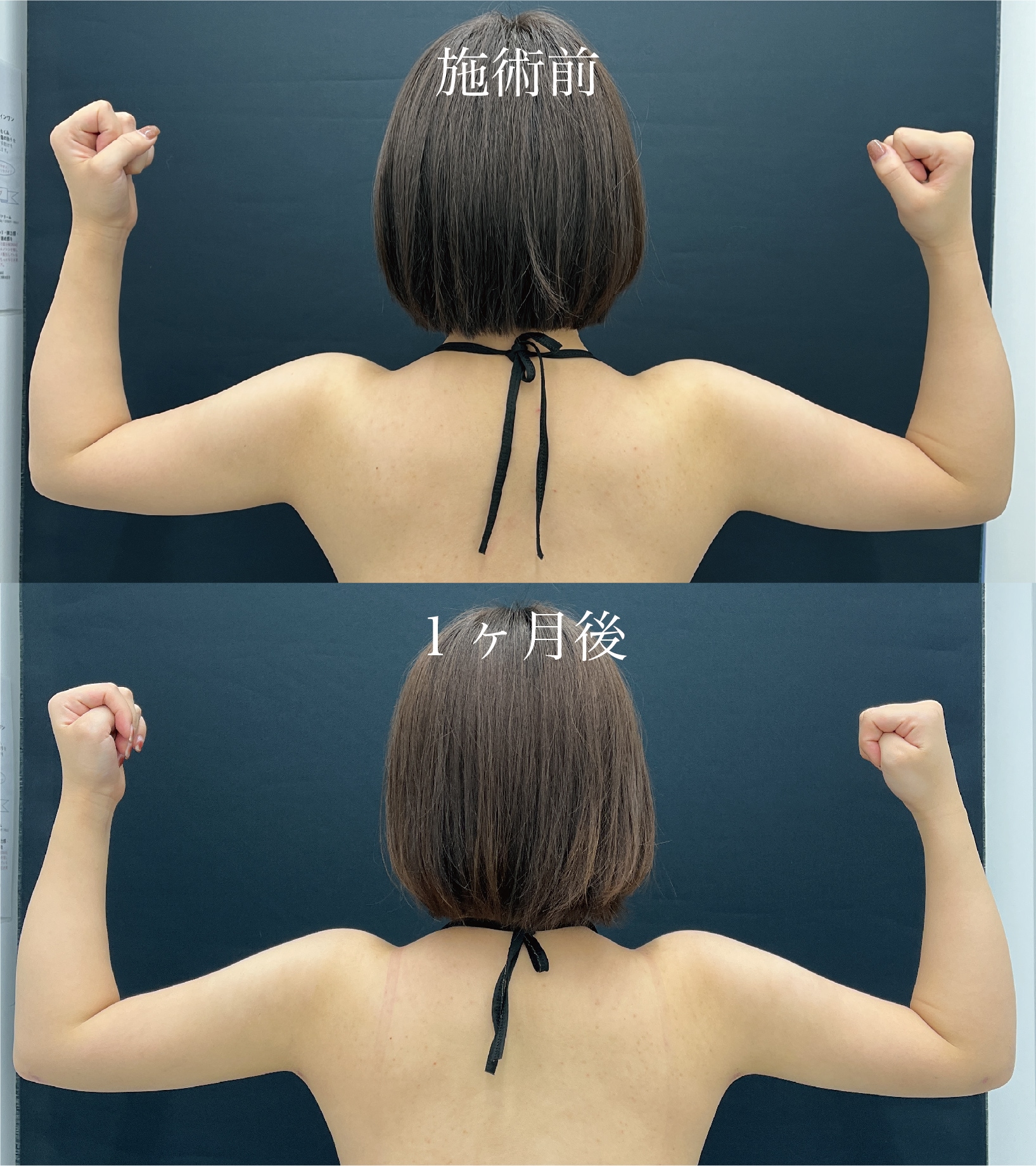 二の腕の脂肪吸引でどれくらい細くなる？
