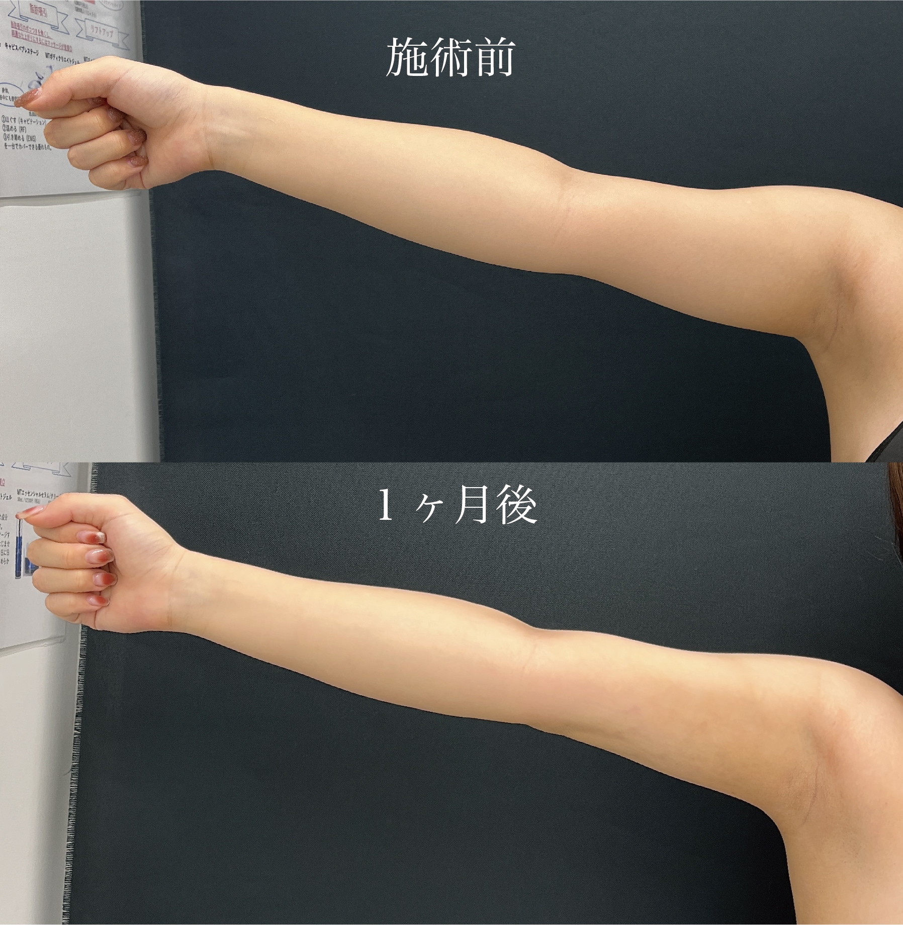 二の腕の脂肪吸引でどれくらい細くなる？