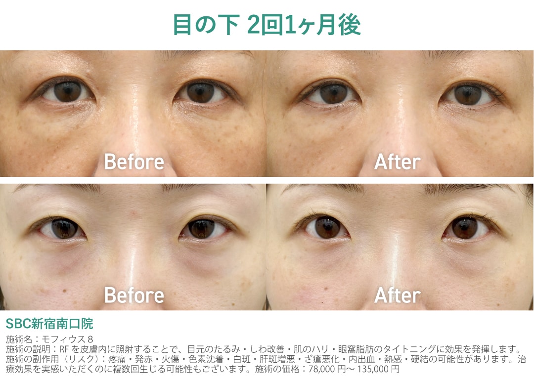 目の下の膨らみ改善