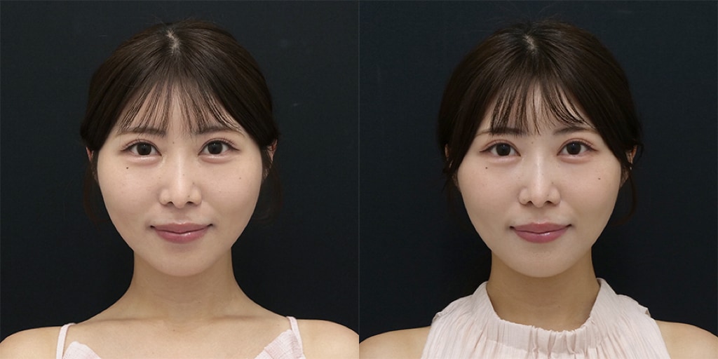 南口院スタッフが受けてみた！！オンダリフト(頬＋顎下)