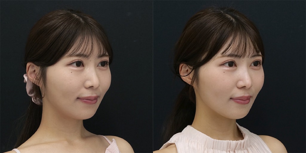 オンダリフト(頬＋顎下)