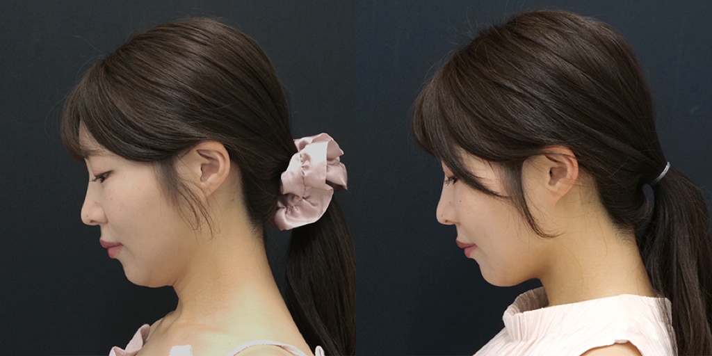 オンダリフト(頬＋顎下)