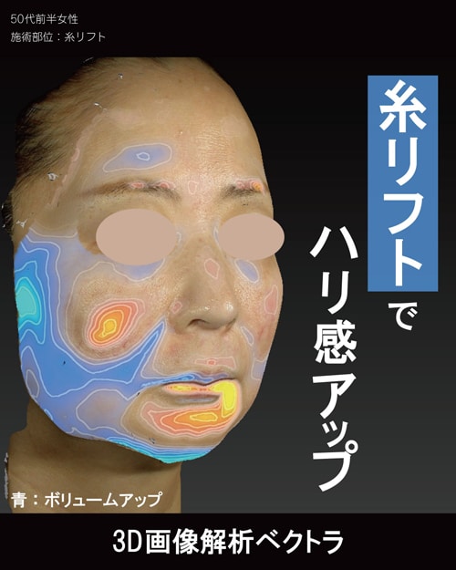 テスリフト10本+VOVリフト4本+シークレットリフト4本