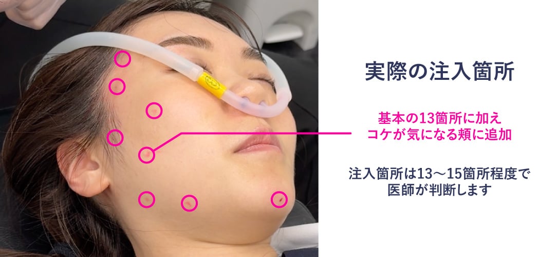頬コケ改善で肌表面をなめらかに