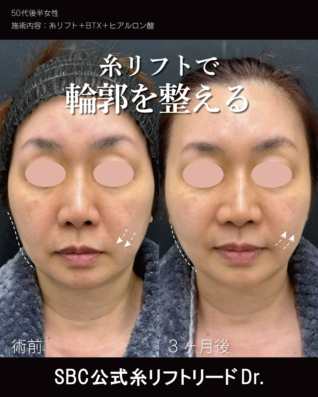 糸リフト