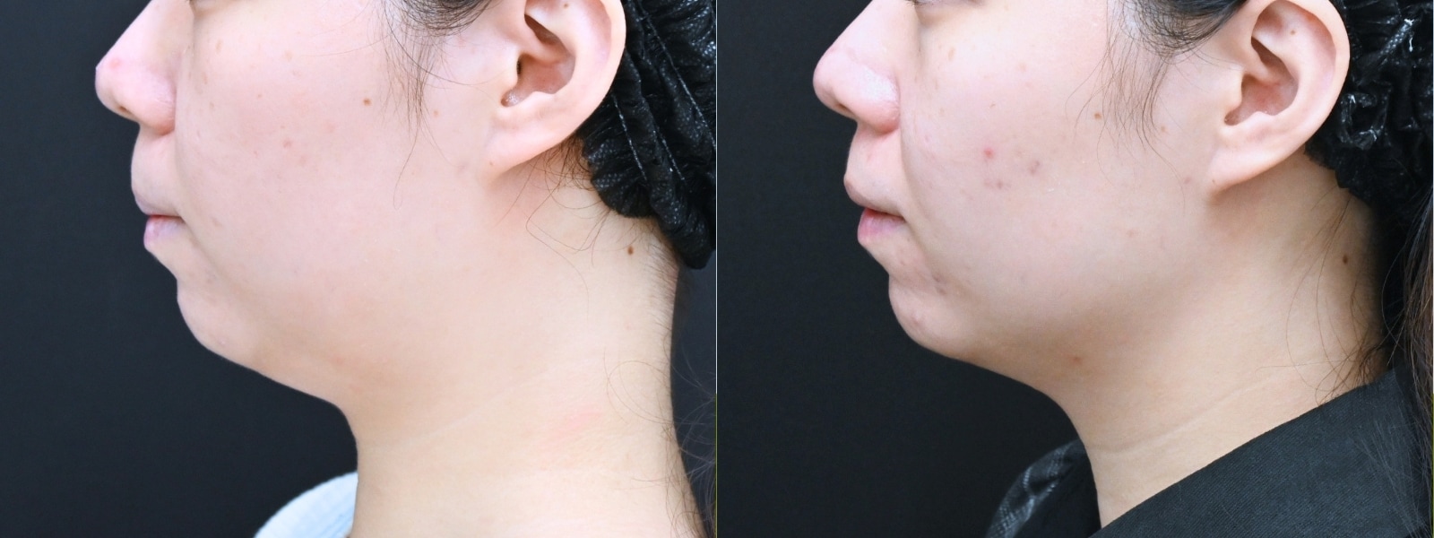 オンダリフト(頬＋顎下)