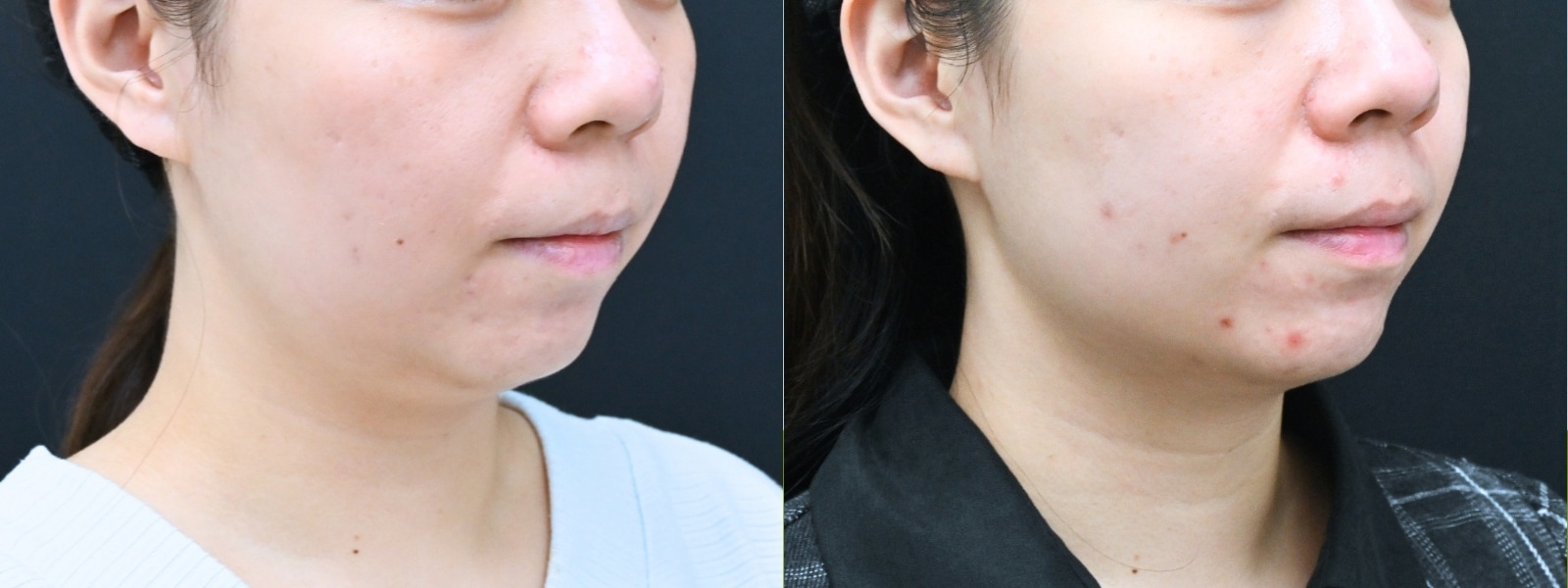 オンダリフト(頬＋顎下)