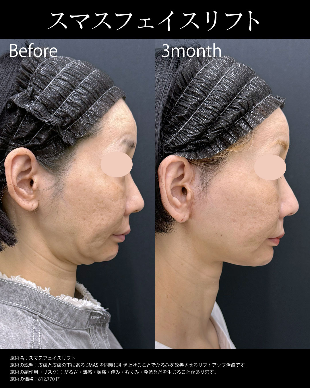 フェイスリフト