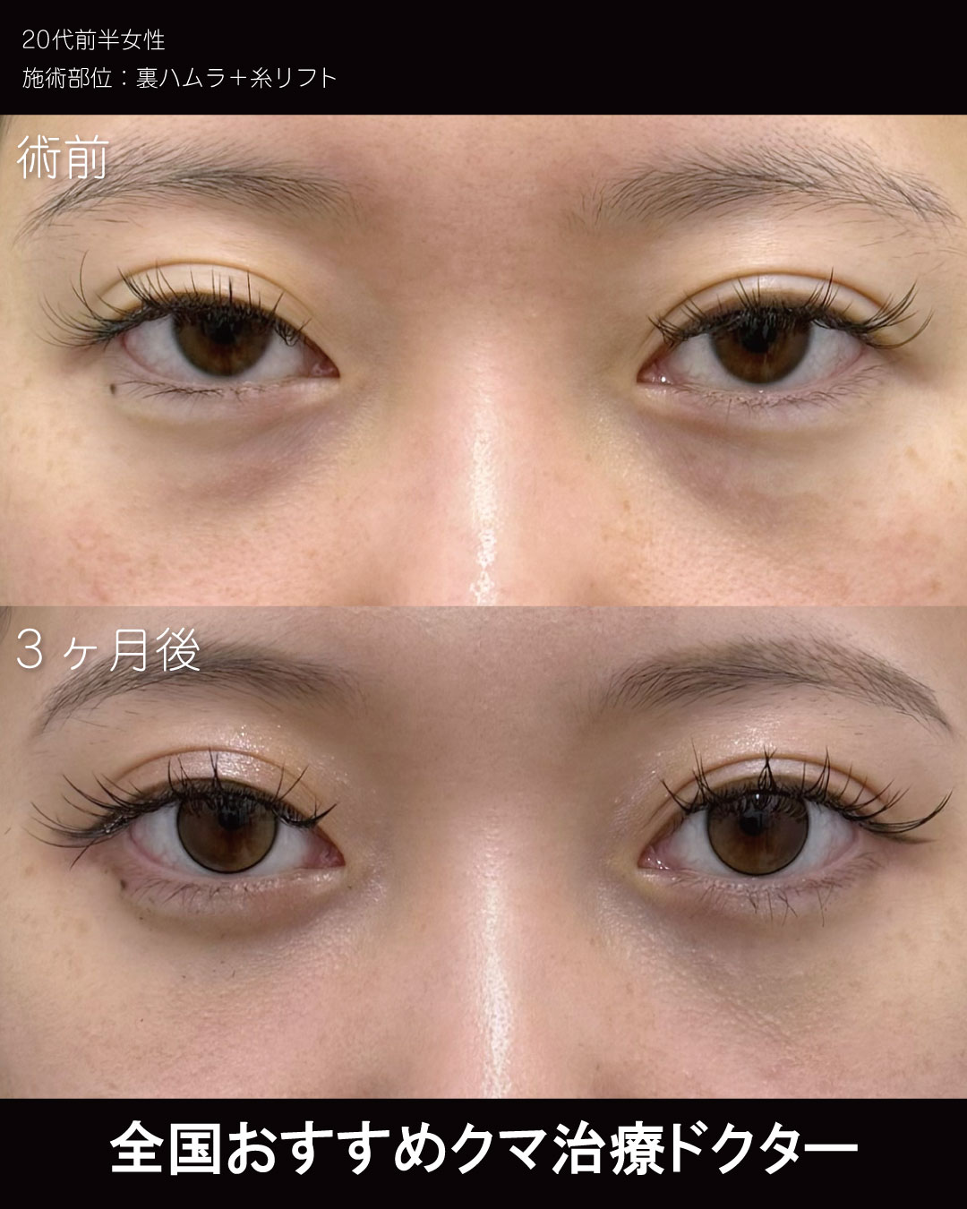 裏ハムラ